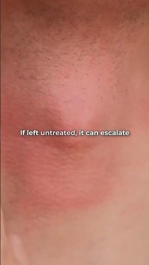 Cat Bites: Small Wound, Big Danger?#CatBiteInfection#ZoonoticDiseases#MicrobiologyFacts