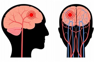 Transient ischaemic attack (TIA): what it is and how to deal with it