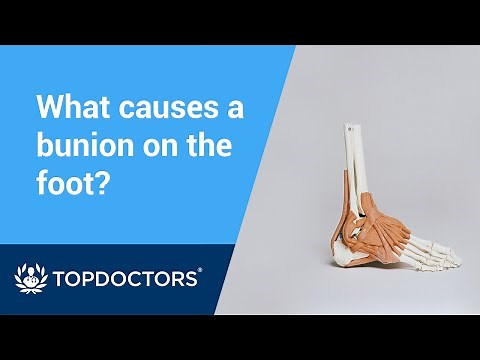 What causes bunions?