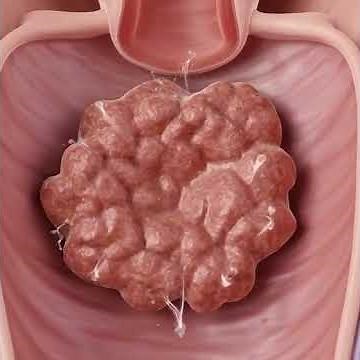 How Uterine Fibroids Form Inside the Uterus | 3D Medical Animation 🩺