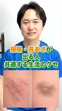 【絶対見て！】細絡・青あざができやすい人の共通点。血流を促す1分体操