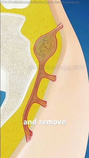 Pilonidal Cyst Treatment!! (3D Animation) #cyst #treatment #technique #hair #3danimation