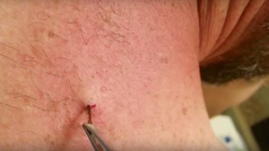 This Viral Video Shows What It Looks Like To Remove a Six-Year-Old Ingrown Hair
