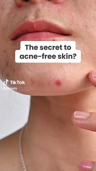 Effective Acne Treatment with The Acne Cream