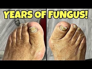 Fungal Nail Transformation 🔥