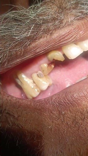 Gum Recession and Bone loss buccal side #dentalprosthesis