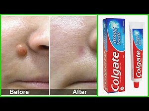 Remove Skin Tag In 1 Night By Applying Toothpaste || S.C