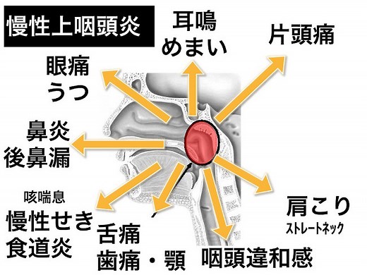 上咽頭炎を治すツボはこの二つだ　完骨と翳風 - 福岡のみらいクリニック