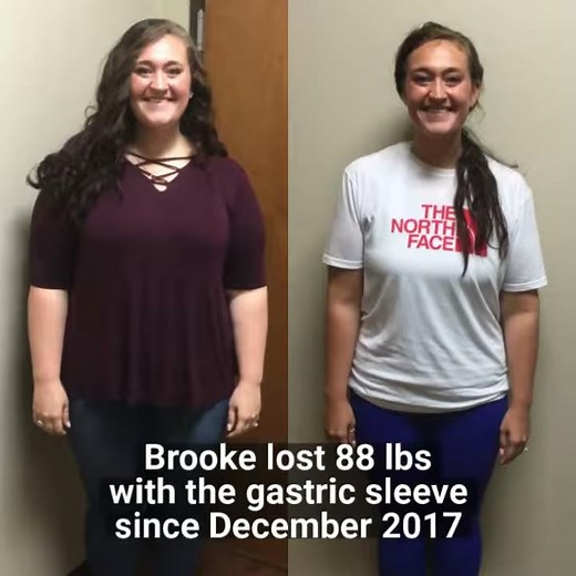 Gastric Sleeve surgery patient before and after