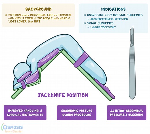Jackknife Position: What Is It, Uses, and More | Osmosis