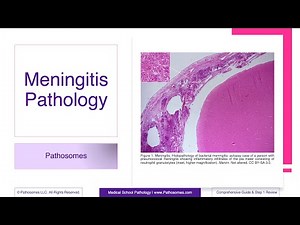 Meningitis Pathology | Comprehensive Guide & Step 1 Review | Pathology Step 1 USMLE