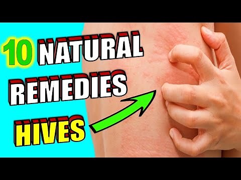 10 Natural Remedies for Skin Hives (TREATMENT AT HOME)
