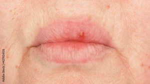 Herpes oral cold sore blisters on the woman lips, herpes simplex
