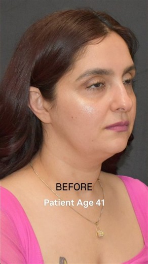 WAIT for this Extended Deep Plane Facelift Transformation! Dr. Yula Indeyeva #beforeandafter