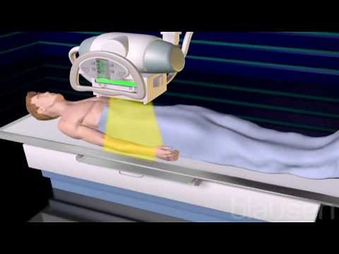 CT Scan for Stomach Cancer CTCA
