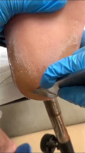 Callus removal from feet&Foot scraping dead skin【Xiao Yan pedicure】#stress 1112 | Xiao Yan Pedicure