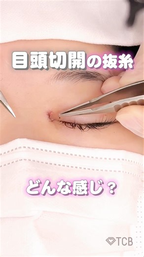 【二重整形】目頭切開の抜糸ってどんな感じ？#shorts
