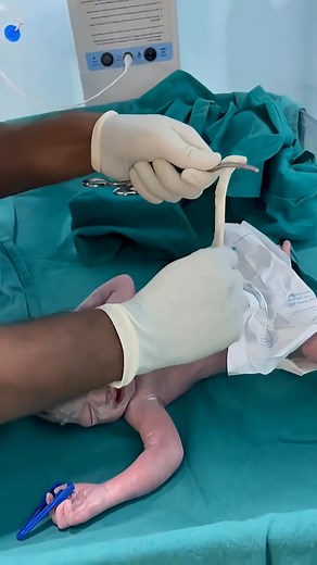 Newborn’s First Moments: Cord Clamping Procedure in the NICU #god #niculife #nicumiracle #facts #nicucare #baby #newborncare #viralreelschallenge | Gautam Ashish