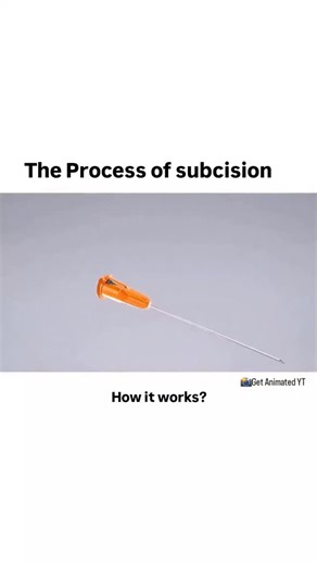 World of Biology on Instagram: "@world_of_biology_wob2 - Subcision is a minor surgical procedure used to treat depressed scars, wrinkles, and certain skin conditions like acne scars. It works by releasing the fibrotic strands that tether the skin down, allowing the surface to lift and smooth out over time. . . Animation credit 📸- Thanks to "Get Animated Youtube channel " for this amazing video ♥️ Link to original video 👇 https://youtu.be/xZWryA63s0Q?si=Qa2XgMSa0kFLxfTr . . How Subcision Works: