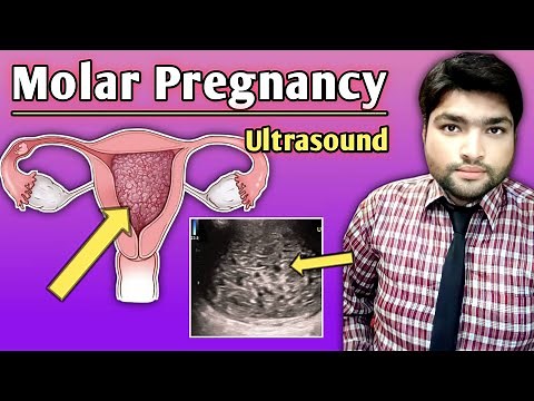Understanding Molar Pregnancy Ultrasound | A Comprehensive Ultrasound Guide by Dr Ali Waqar