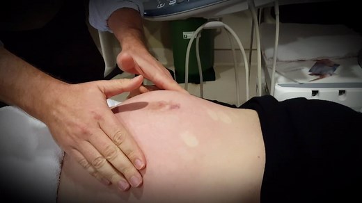 External Cephalic VERSION - ECV procedure