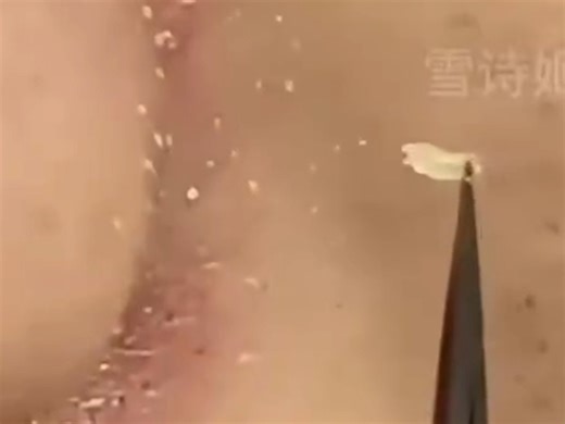 拔黑头极度舒适解压，超解压!