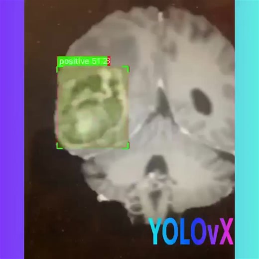 Brain Tumor Detection - YOLOvX | YOLOvX