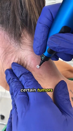 Cryotherapy Explained by US Doctors #reels #facts