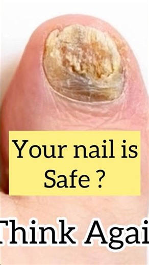 What’s hiding inside this infected nail? KOH mount reveals fungal hyphae! 🔬🦠 #science #microscope