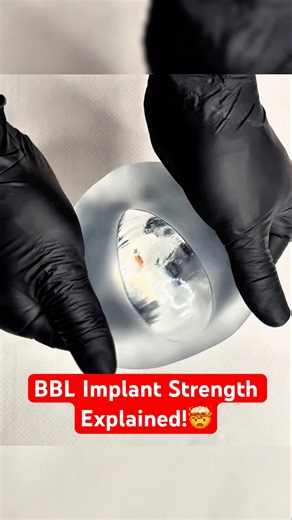 BBL Implants Are Way Stronger Than You Think