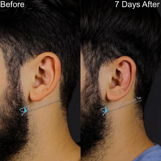 Otoplasty Surgery | Before And 7 Days After