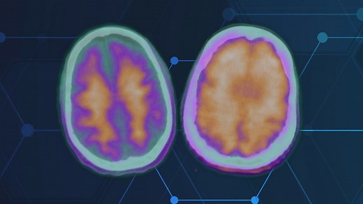 Alzheimer's breakthrough: FDA approves new treatment targeting brain plaque