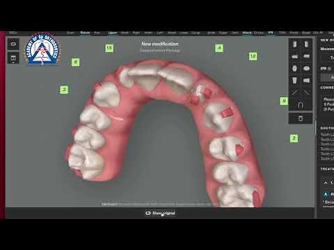 Monday Tip: How to move Peg Laterals with Clear Aligners!
