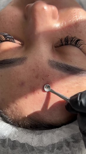 Effective Whitehead Extraction Skincare Procedure