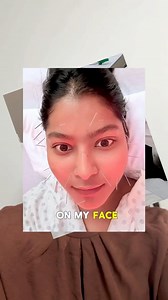 I finally tried facial acupuncture and micro needling for my face and acne scars and yes, I actually put needles on my face! I’ve been planning this for a long time, and I finally did it at @vuimclinic Watch the full video to find out if it was a hit or a miss✨ | Marishaa Rahman