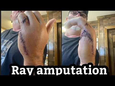 Ray finger and hand amputation after 5 days of healing. Day by day process (first week)