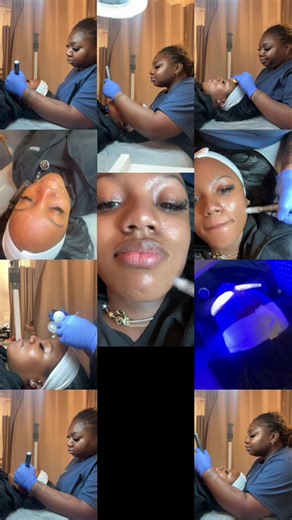 Benefits of Nano Needling Here are the main advantages: ✨ Increases product absorption The nano-tips create micro-channels in the very top layer of the skin, allowing serums to penetrate much deeper and work more effectively. ✨ Improves skin texture and tone It helps smooth roughness, soften fine lines, and create a more even complexion. ✨ Brightens dull skin Nano-needling boosts circulation and speeds up cell turnover, giving the skin a healthy, refreshed glow. ✨ Reduces the appearance of fine 