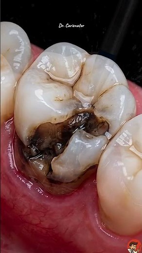 How to Restore a Molar (Step-by-Step)
