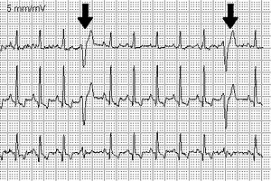 Arrhythmias, when the heart 'stutters': extrasystoles | Emergency Live