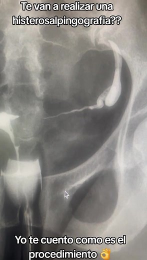 Histerosalpingografía: Proceso y Propósitos Médicos