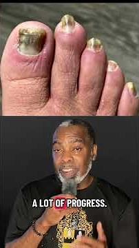 Curing Fungal Toenail Infection #podiatry #footcare #fungaltoenails onychomycosis cure