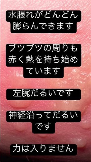 閲覧注意⚠️帯状疱疹の過程その②プクプク水脹れです