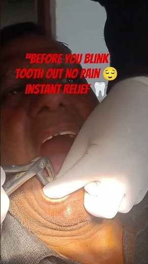 “Before You Blink… Tooth Gone!Tooth Out in Seconds #thedentalguru#dentist #Painless Extraction