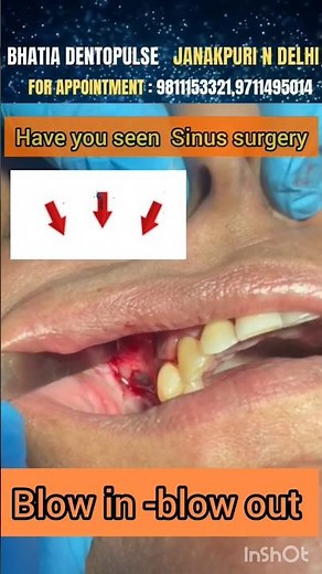Sinus surgery -live