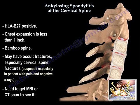Ankylosing Spondylitis Of The Cervical Spine - Everything You Need To Know - Dr. Nabil Ebraheim