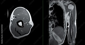MRI Left humerus bone Axial and Coronal T2W for diagnosis bone tumor.