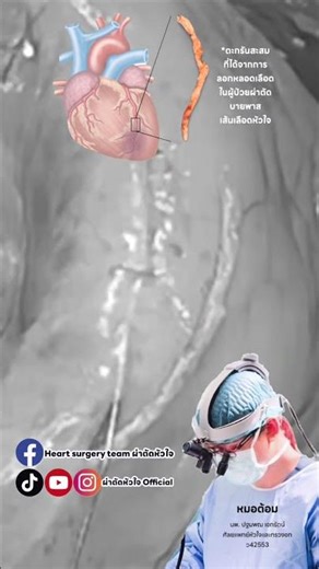 ⚠️🔧🫀ลอกหลอดเลือดในผู้ป่วยผ่าตัดบายพาสเส้นเลือดหัวใจ (Coronary Endarterectomy) I Now You See Me🫀EP22