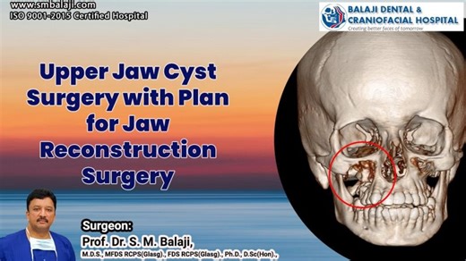 Upper Jaw Cyst Surgery with Plan for Jaw Reconstruction Surgery | Balaji Dental and Craniofacial Hospital