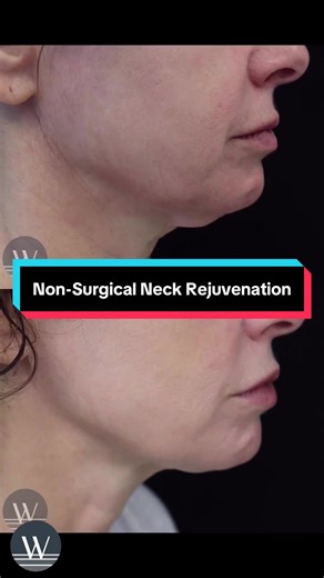 👩🏻‍⚕️ Just a few years ago, we couldn’t have told you that we could do this … Significant improvement of skin laxity, wrinkles, and blotchiness on the neck … All without surgery! 💥 Sofwave™️ is a gentle ultrasound treatment that has ZERO downtime … Receive this 45 minute treatment and walk out of the office with no redness, bruising or swelling ⏳ Come back 3 months later for your photo and it will look like one of these… A snatched, contoured, sculpted jawline, lifting of cheeks and jowls and