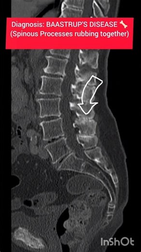 Why are these Bones KISSING? 💋🦴 (Baastrup's Disease) #shorts #radiology #educational